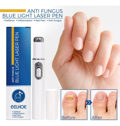 2 Canetas Laser Para Fungos Em Unhas Quentes Com Luz Azul