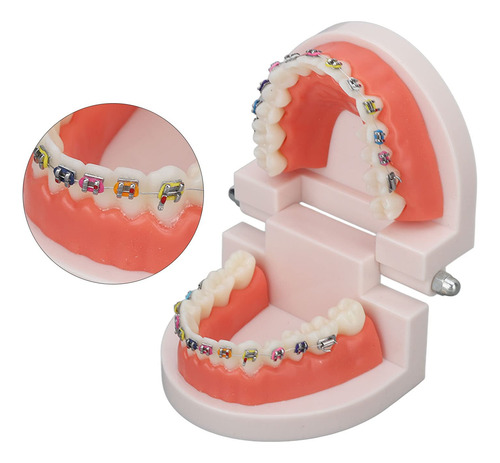 Modelo De Dientes De Ortodoncia Con Soportes De Metal De