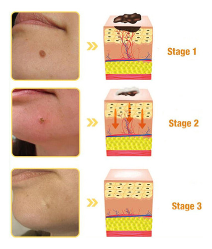 Crema Antipigmentaria Para Eliminar Las Verrugas Del Herpes,