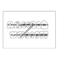 Comprar Gomas Intraorales Ortodoncia Smile Safari Ortodoncia Odontol