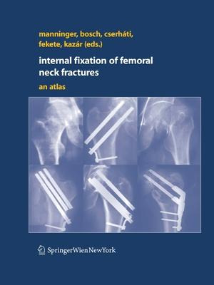 Libro Internal Fixation Of Femoral Neck Fractures : An At...