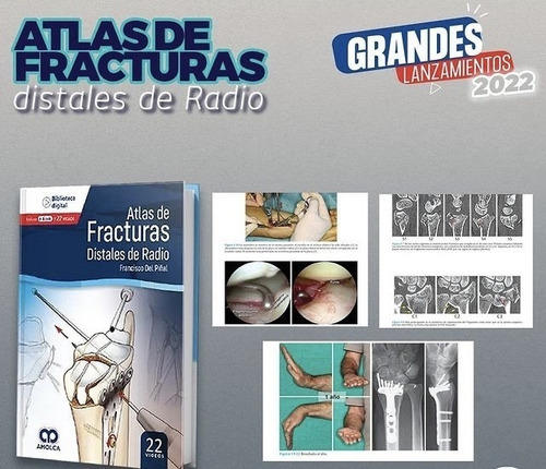 Atlas De Fracturas Distales De Radio + E-book, De Francisco Del Piñal., Vol. 1. Editorial Amolca, Tapa Dura, Edición 1 En Español, 2022