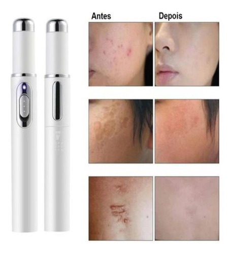 Caneta Tratamento Varizes/acne E Cicatrizes - Luz Led