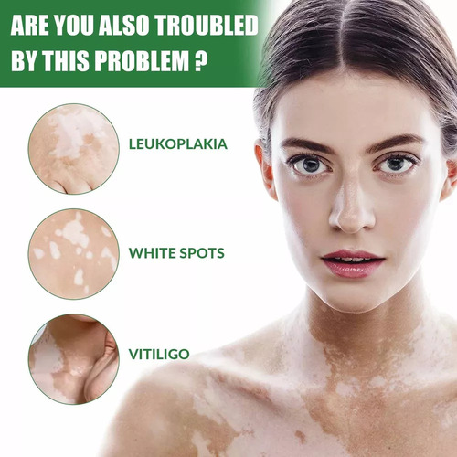 . Pomada Blanca Para El Vitíligo, Crema Para La Micosis, Leu