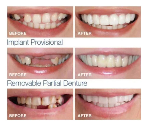 Carillas De Silicona Superiores E Inferiores Para Dientes De