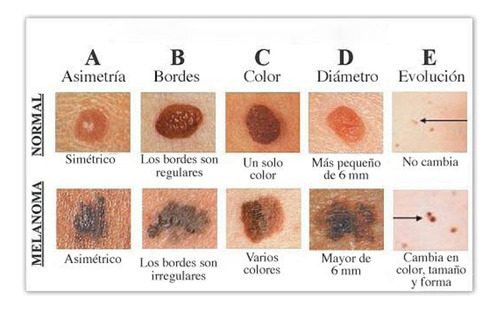 Anti Acne Elimina Granitos Puntos Negros Natural Y Saludable