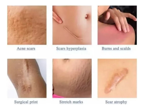 Cinta Silicona Cicatriz Cicatrizante Facial Corporal !!!!