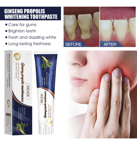 Clareamento De Própolis De Ginseng Como Dor Dentária, Dentes