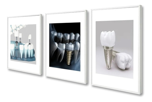 Kit Quadros Decorativos De Odontologia Implante Dentista 