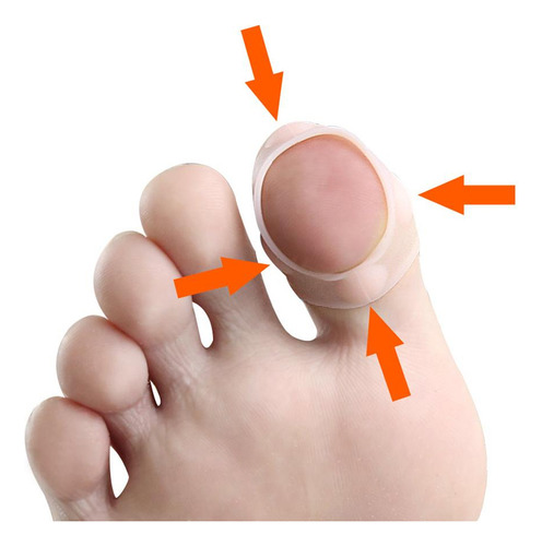 Gel Para De Uñas De Pies Encarnados De Silicona De 5 Pares,
