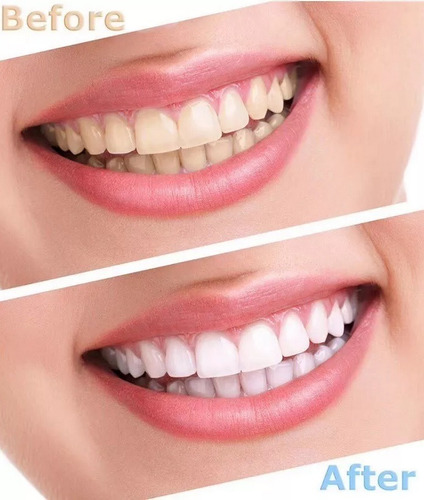 Blanqueador Dental Whitening Oral Gel 44% Peroxido Premium
