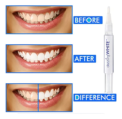 Bolígrafo Blanqueador Instantáneo Natural Dazzling White Sin Sensibilidad Advance, Bolígrafo Blanqueador De Dientes, Bolígrafo Blanco Brillante Para Iluminar Los Dientes, Blanqueador De Dientes