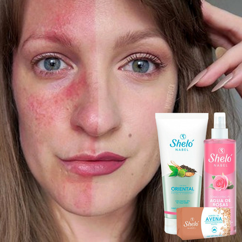 Imagen 6 de 6 de Crema Rosacea Piel Sensible Pack Natural + Jabón Y Tonico
