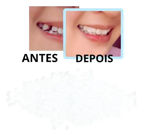 Massinha Restauração Dente Provisório+ De 300 Bolinhas Massa | MercadoLivre