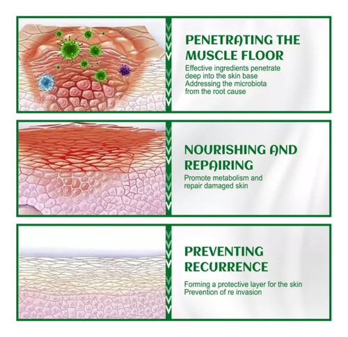Crema Para Dermatitis Seborreica, Psoriasis Y Foliculitis.