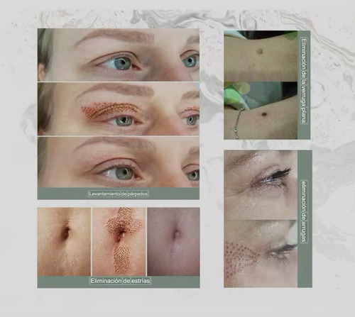 Plasma Pen Monster Profesional Puntas Fibroblast Electrolift