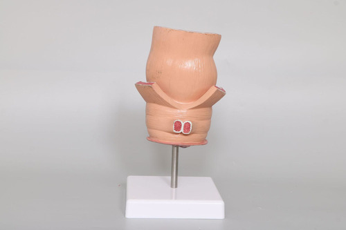 Yi Modelo Recto Patológico Humano, Modelo Recto Dañado