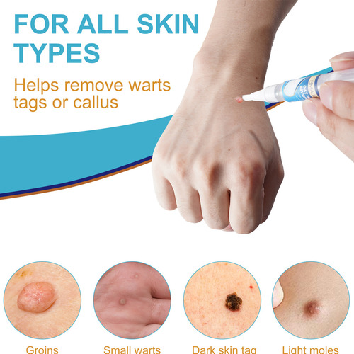 Caneta De Remoção De Verrugas Para Remover Caneta Para