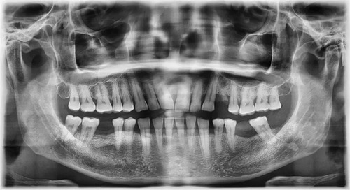 Imagen 1 de 6 de Radiografía Panorámica Dental