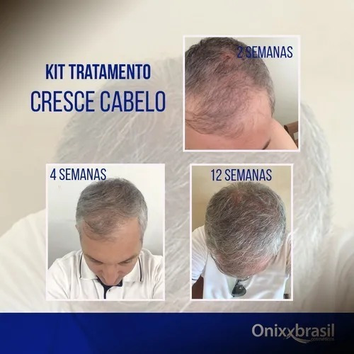 Kit Cresce + Nasce Cabelo + 1 Shampoo Extra - Onixx