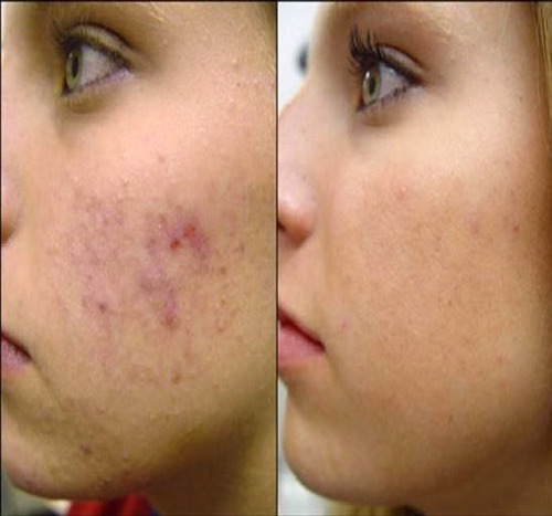 Gel Cicatrizante Antialergias Y Antiacne De Calendula 60ml