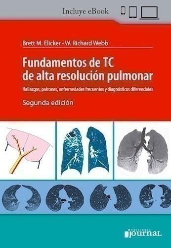 Fundamentos De Tc De Alta Resolución Pulmonar Hallazgos, Pa