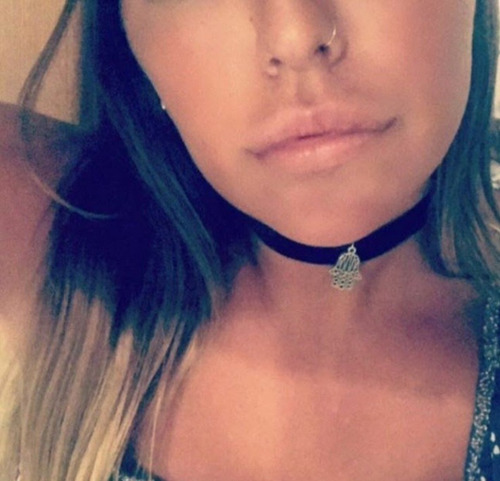 Imagen 3 de 3 de Relleno De Labios Con Acido Hialurónico Reticulado