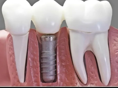 Implante Dental Mas Corona