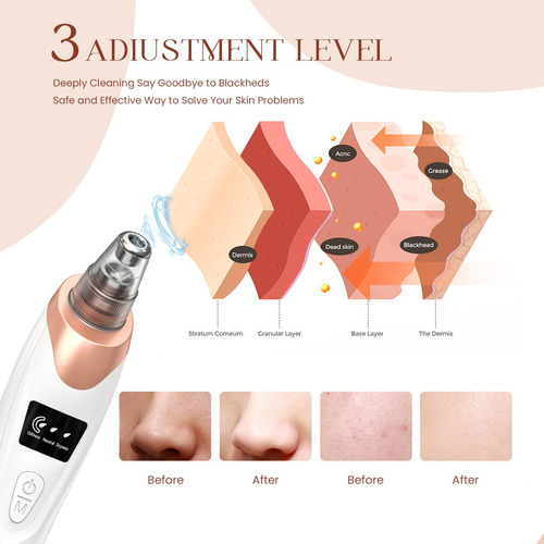 Aspiradora De Puntos Negros Limpiador Facial 5 Potencias Usb Color