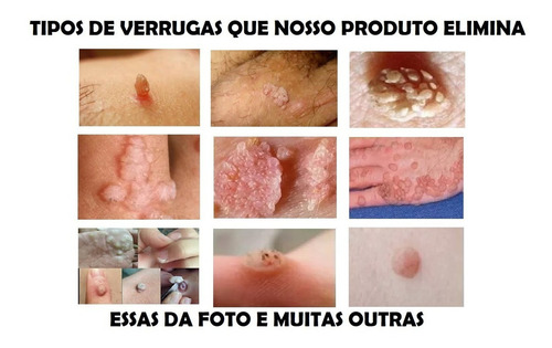 Tca Ata 100% 2,5ml - Ácido Tricloroacético Tipo De Pele Todo Tipo De Pele