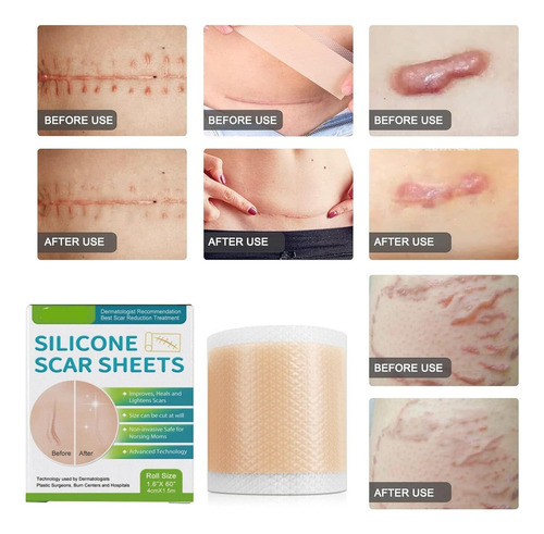 Remendos De Silicone Para Cicatrizesfita De Silicone