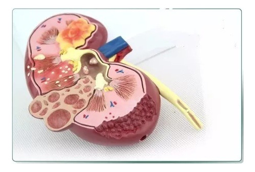 Modelo Anatômico P/ Estudo Rim Com Patologia