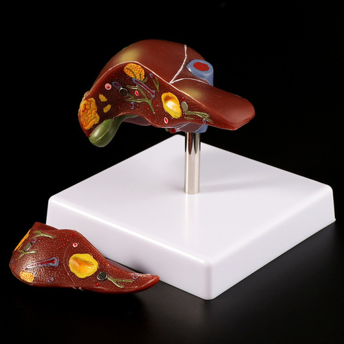 S Fígado Humano Patológico Anatômico Modelo Anatomia Escola