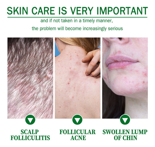 Crema Para Dermatitis Seborreica, Cuero Cabelludo Para Psori