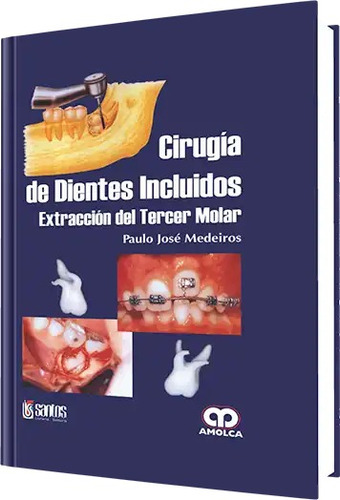 Cirugía De Dientes Incluidos Extracción Del Tercer Molar