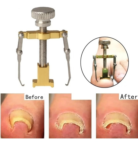 Corrector De Uñas Encarnadas Sin Caja Pedicura Cuida El Pie