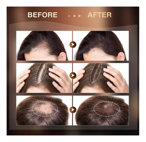 2sérum Re:act Minoxi Roll-on Para El Crecimiento Del Cabello
