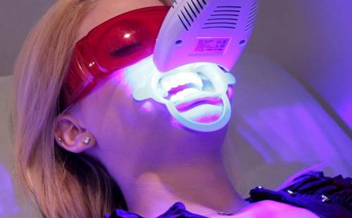 Imagen 1 de 10 de Blanqueamiento Dental Laser