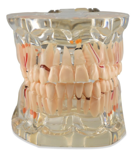 Zeigen Modelo Anatómico De La Dentadura Con Patologías 