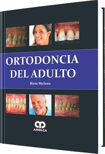 Ortodoncia Del Adulto Melsen