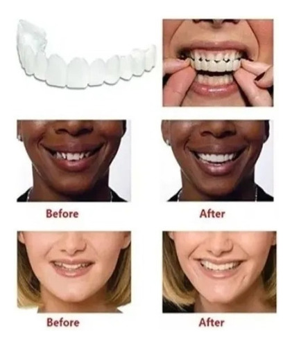 Prótesis Dentadura Postizo Snap On Smile Superior E Inferior