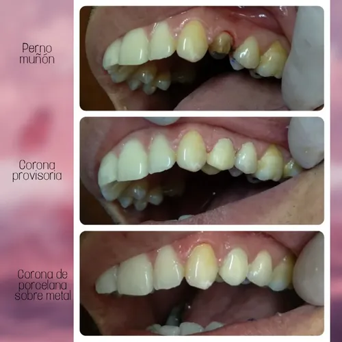Perno Y Corona De Porcelana Dental (incluye Provisorio) en venta en