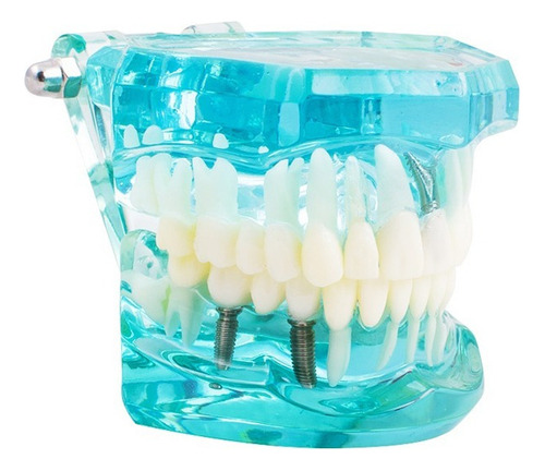 Modelo De Dientes Dentista Patológicos Transparentes