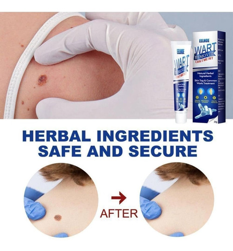 2* Pomada Cremosa Anti-verrugas, Creme Anti-sardas, Removedo