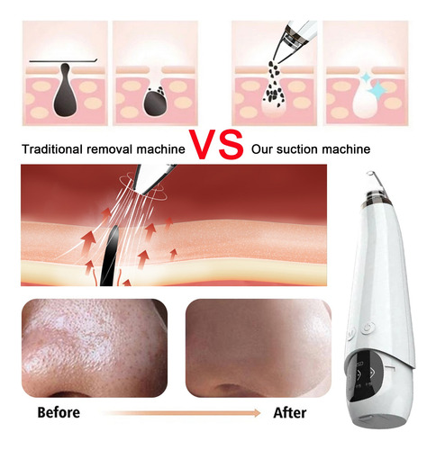 Aspirador De Poros Y Black Head Remover Black Head Vac 6012