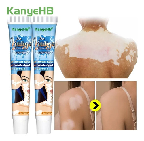 Crema China Para Tratar Vitiligo 