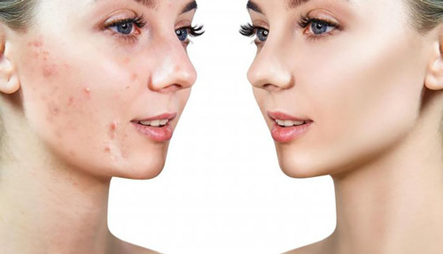 Imagen 2 de 4 de Acnepril Pildoras Para Eliminar El Cutis Curar El Acne