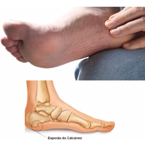 Imagem 6 de 6 de Palmilha Ortopédica De Silicone Para Esporão Facite Impacto