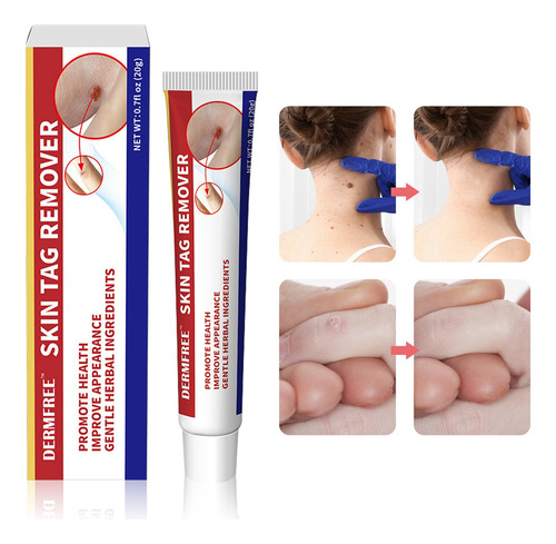 Crema Para Verruga Spointts Sigermel Antiverrugas Anti-vph