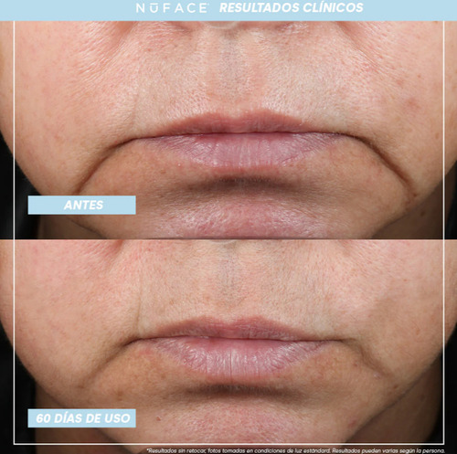 Tonificador Facial Con Microcorrientes Nuface Mini+ Negro Rejuvenecimiento Limpiador Y Masajeador Eléctrico Recargable